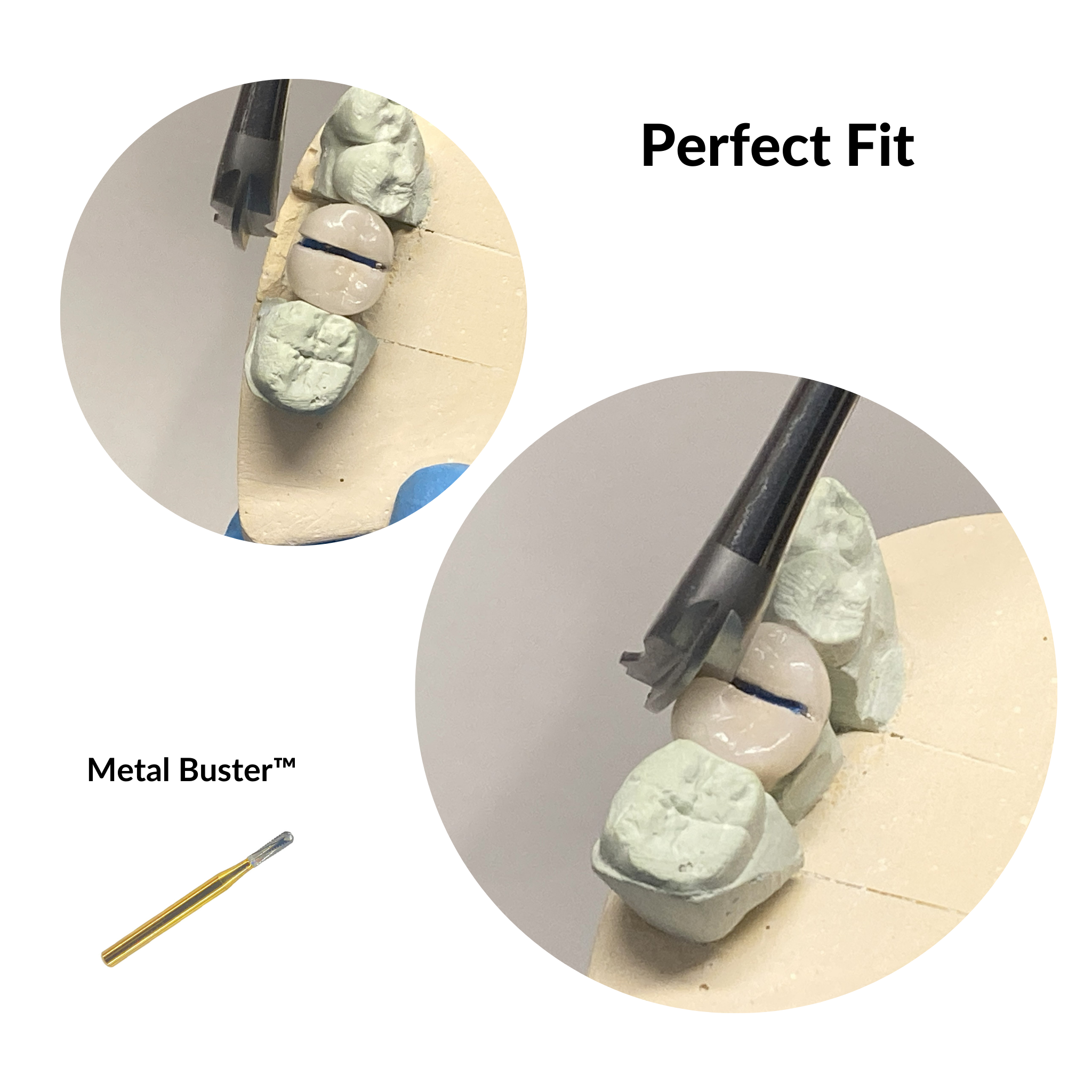 Dentist using Max Crown Spreader instrument during crown removal procedure after access slot preparation