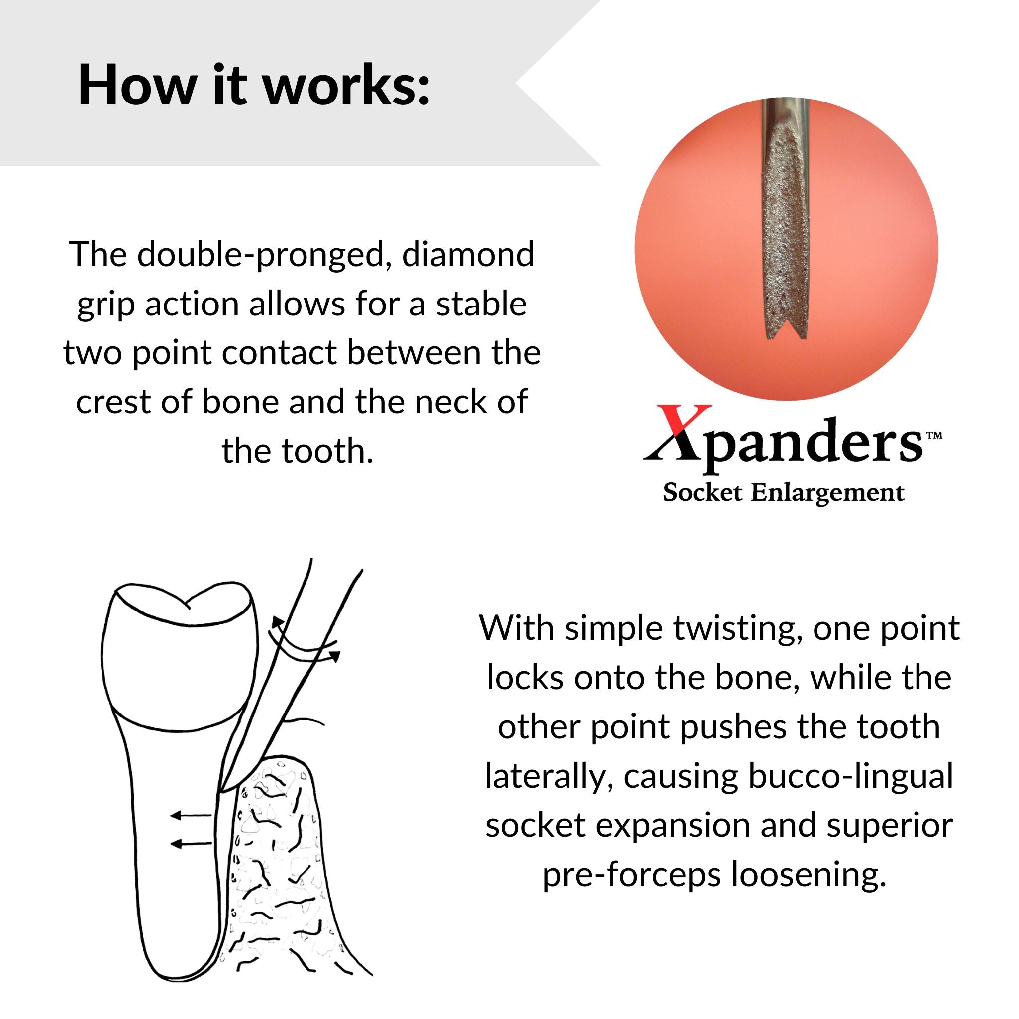 How Xpanders dental elevator works bucco-lingual socket expansion