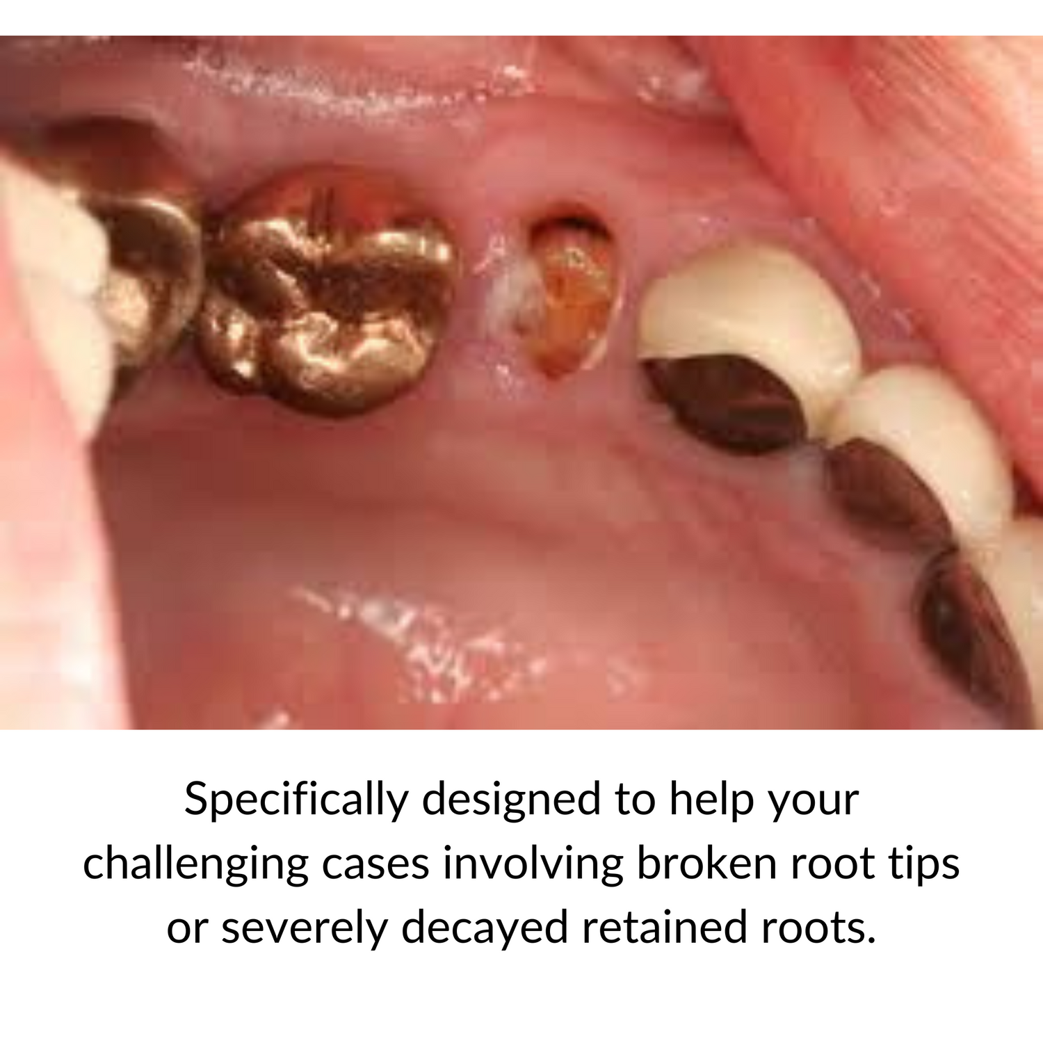 Golden Retrievers™ | Dental Root Elevator | Root Tip Elevator
