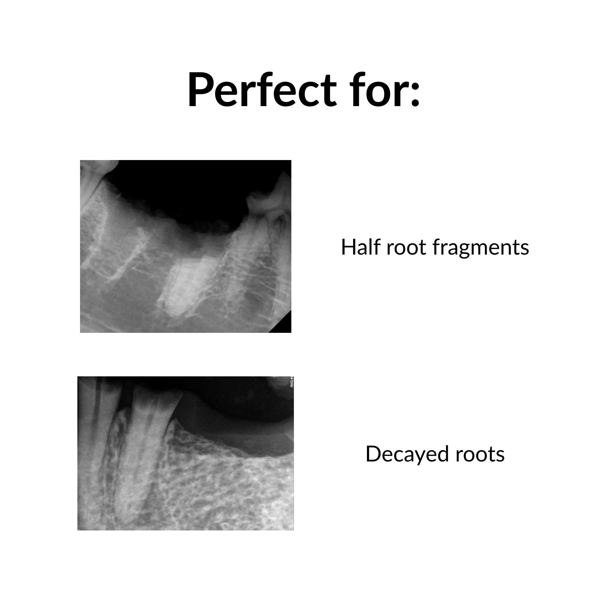 RootGripp™ Stieglitz Forceps