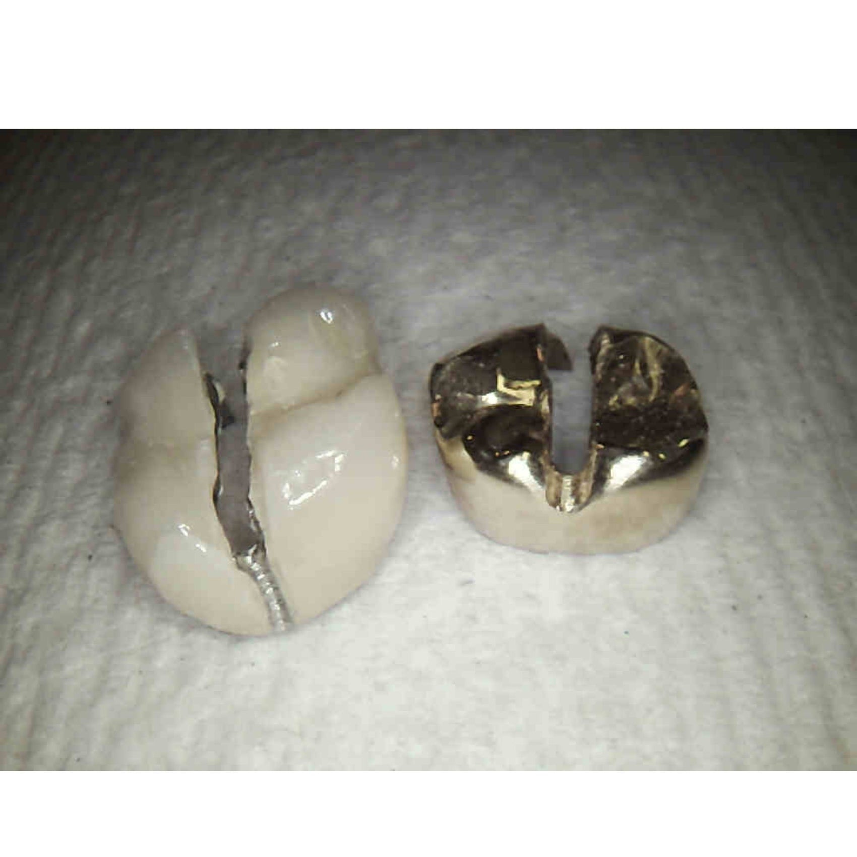 Dental Crown Removal How to Remove a Dental Crown in Under a Minute W