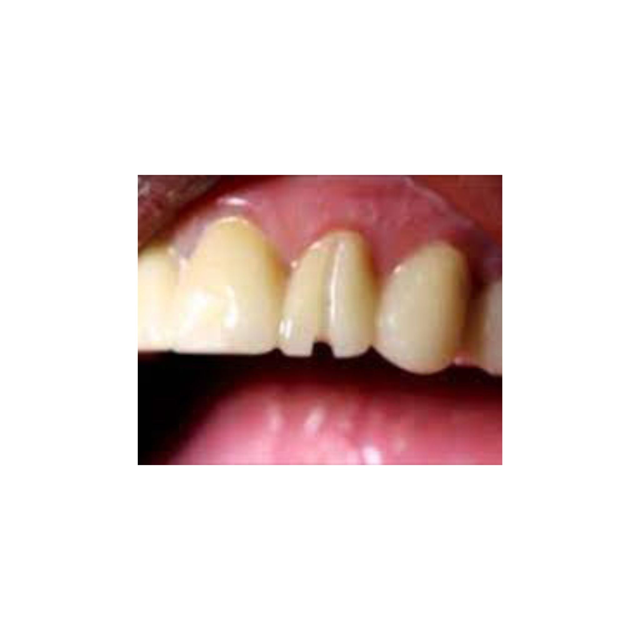 Zirconia Buster™